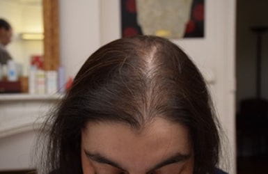 Résultat avant de 400 implants hairstetics chez la femme à La Rochelle
