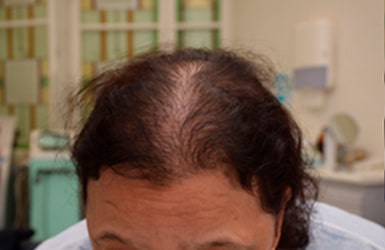 Résultat avant de 700 implants hairstetics chez la femme à La Rochelle