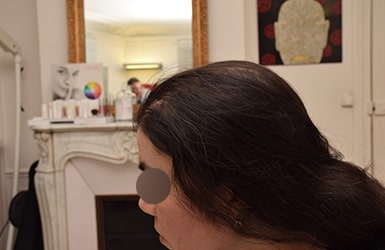 Résultat après traitement alopécie avec 400  implants hairstetics chez la femme à La Rochelle