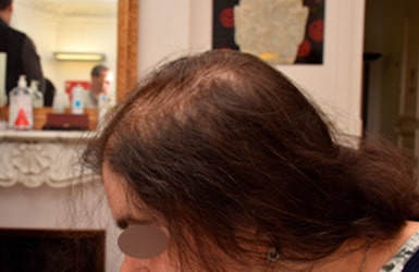 Résultat avant traitement alopécie avec 400 implants hairstetics chez la femme à La Rochelle