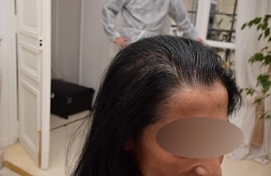 Résultat après traitement alopécie avec 600 implants hairstetics chez la femme à La Rochelle