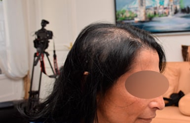 Résultat avant traitement alopécie avec 600 implants hairstetics chez la femme à La Rochelle