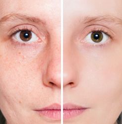 acne traitement la rochelle acnes visage blanchard